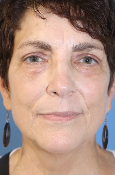 Eyelid Lift Before & After Gallery - Patient 146225342 - Image 2