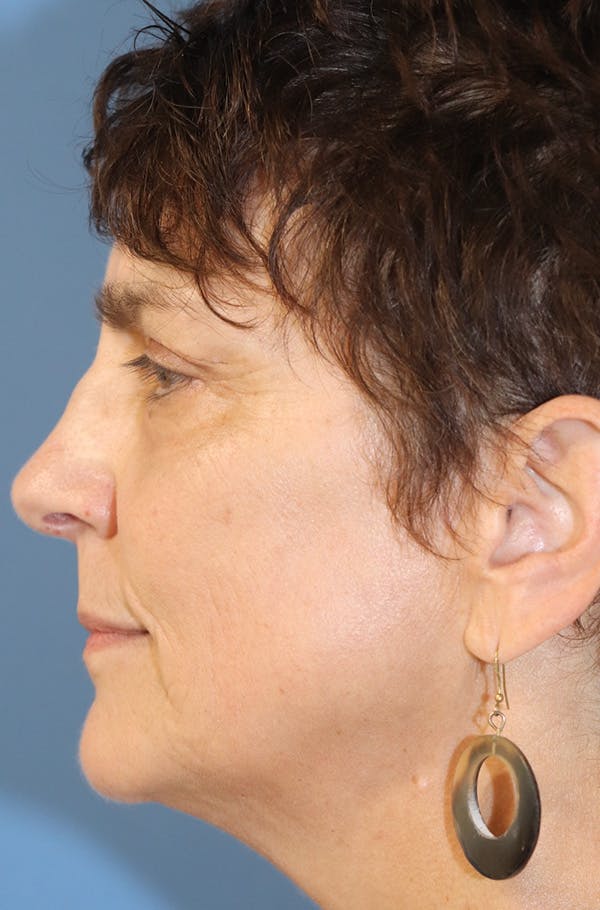 Eyelid Lift Before & After Gallery - Patient 145354790 - Image 4