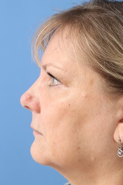 Mole Removal Before & After Gallery - Patient 145354855 - Image 1