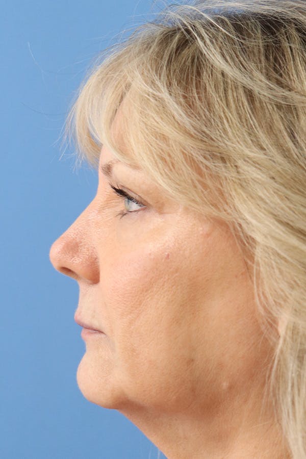 Mole Removal Before & After Gallery - Patient 145354855 - Image 2
