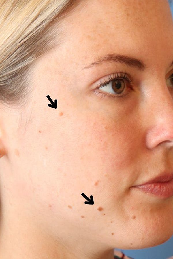 Mole Removal Before & After Gallery - Patient 145354857 - Image 1
