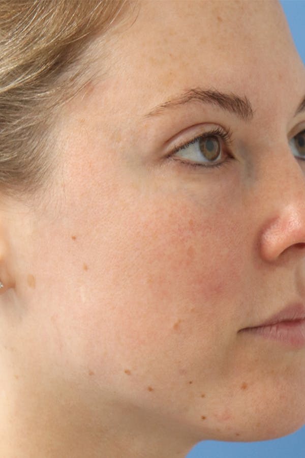 Mole Removal Before & After Gallery - Patient 145354857 - Image 2