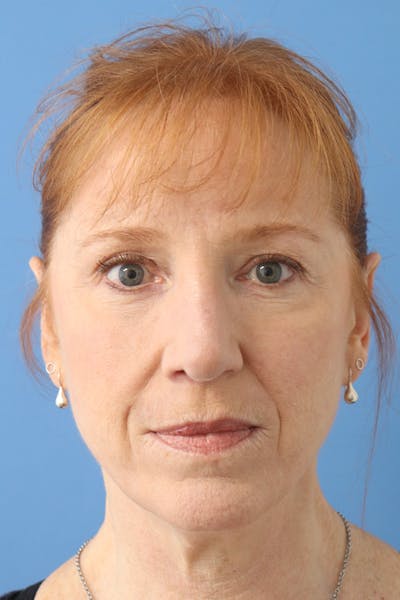 Rhinoplasty Before & After Gallery - Patient 145354864 - Image 4