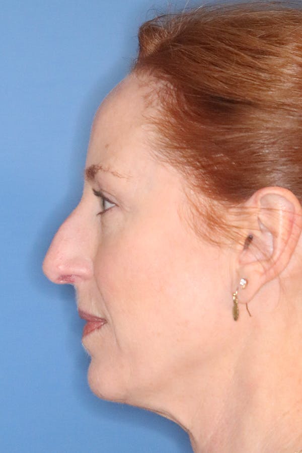 Rhinoplasty Before & After Gallery - Patient 145354864 - Image 1