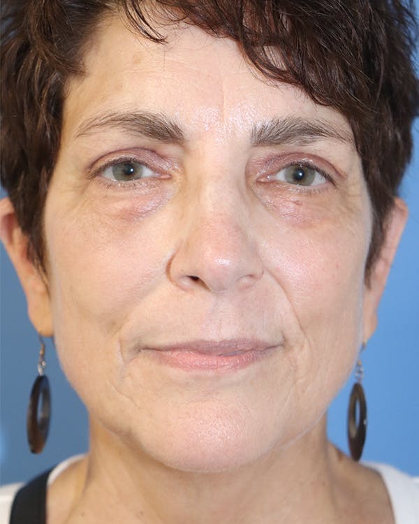 AccuTite Before & After Gallery - Patient 145354896 - Image 2