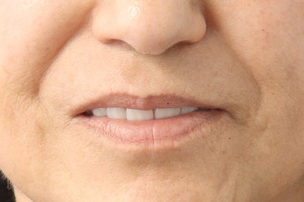 Lip Filler Before & After Gallery - Patient 145354907 - Image 1