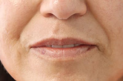Lip Filler Before & After Gallery - Patient 145354907 - Image 2