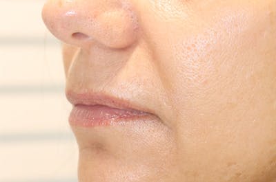 Lip Filler Before & After Gallery - Patient 145354904 - Image 1