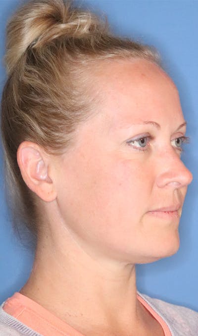 Cheek & Under Eye Filler Before & After Gallery - Patient 145354925 - Image 1