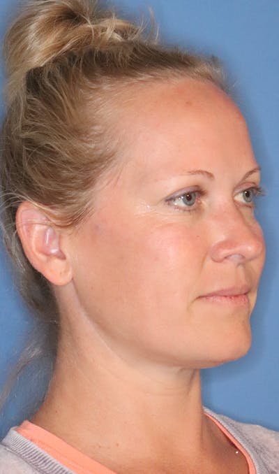 Cheek & Under Eye Filler Before & After Gallery - Patient 145354925 - Image 2
