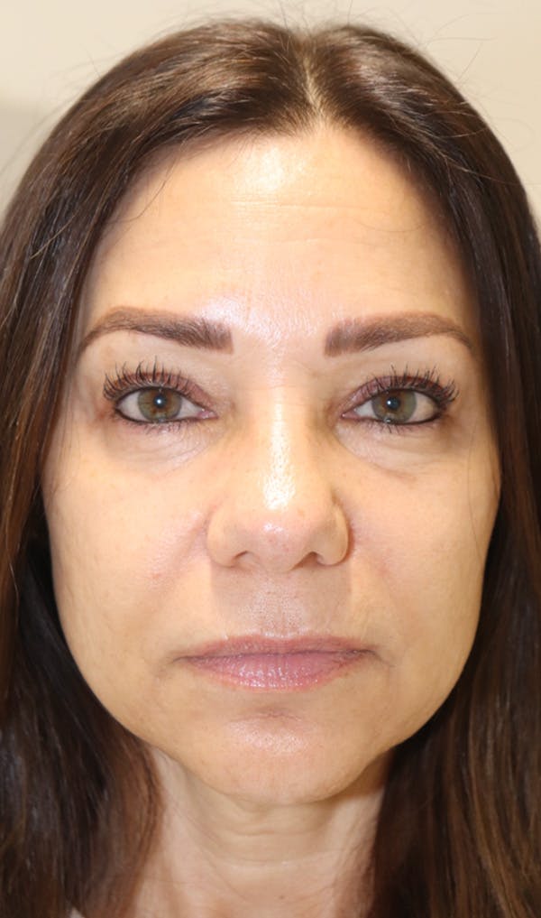 Cheek & Under Eye Filler Before & After Gallery - Patient 145354924 - Image 3