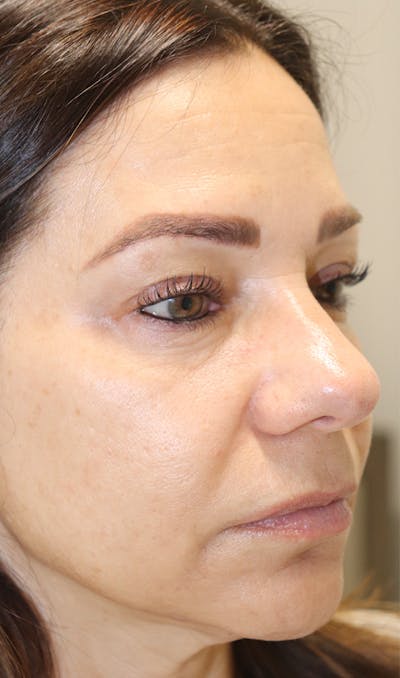 Cheek & Under Eye Filler Before & After Gallery - Patient 145354924 - Image 1