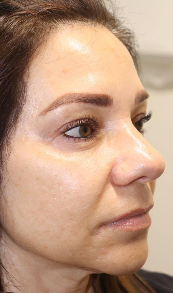 Cheek & Under Eye Filler Before & After Gallery - Patient 145354924 - Image 2