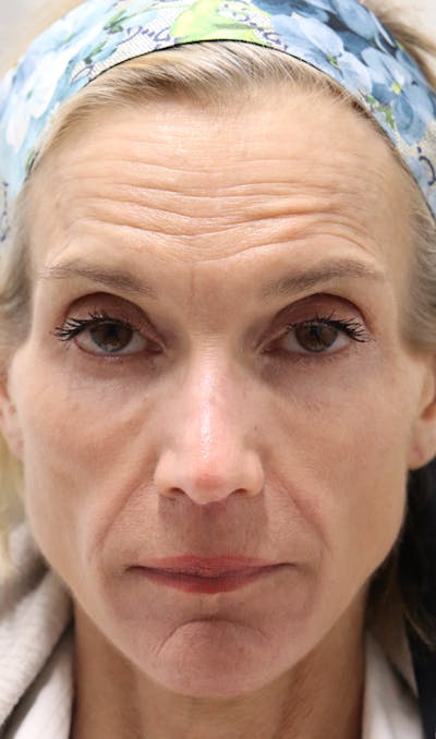 Cheek & Under Eye Filler Before & After Gallery - Patient 145354929 - Image 1