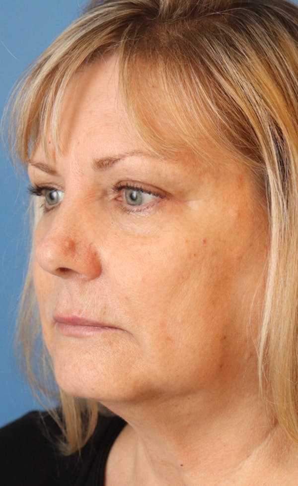 FaceTite Before & After Gallery - Patient 145354947 - Image 1