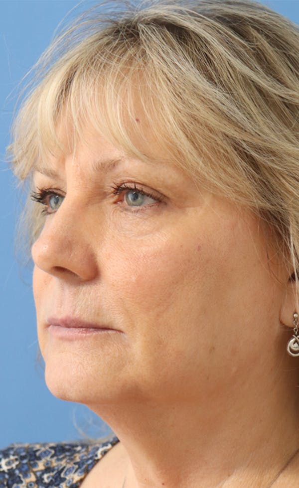 FaceTite Before & After Gallery - Patient 145354947 - Image 2