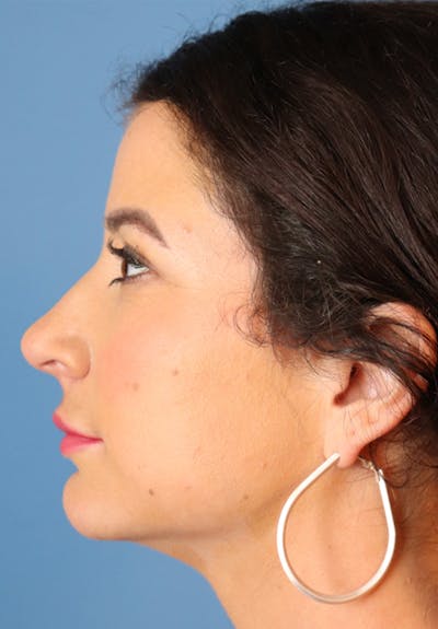 Microneedling Before & After Gallery - Patient 145354950 - Image 4