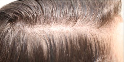 Hair Restoration with Exosomes Before & After Gallery - Patient 145355007 - Image 1