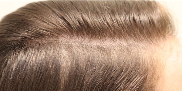Hair Restoration with Exosomes Before & After Gallery - Patient 145355007 - Image 2