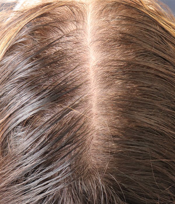 Hair Restoration with Exosomes Before & After Gallery - Patient 145355007 - Image 3