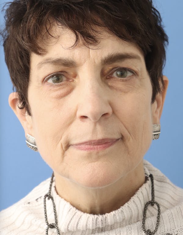 AccuTite Before & After Gallery - Patient 145354896 - Image 1