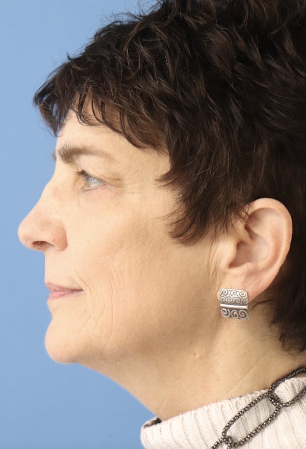 AccuTite Before & After Gallery - Patient 145354896 - Image 3