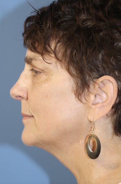 AccuTite Before & After Gallery - Patient 145354896 - Image 4