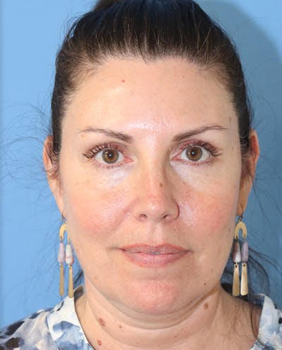 Jawline & Neck Filler Before & After Gallery - Patient 145354938 - Image 4