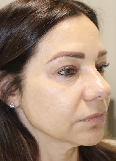 Cheek & Under Eye Filler Before & After Gallery - Patient 145354924 - Image 1