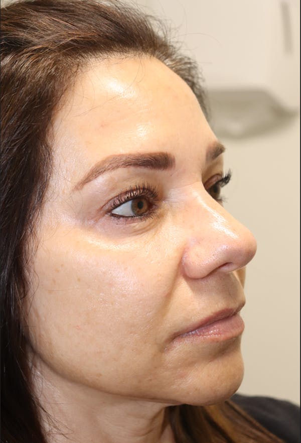 Cheek & Under Eye Filler Before & After Gallery - Patient 145354924 - Image 2