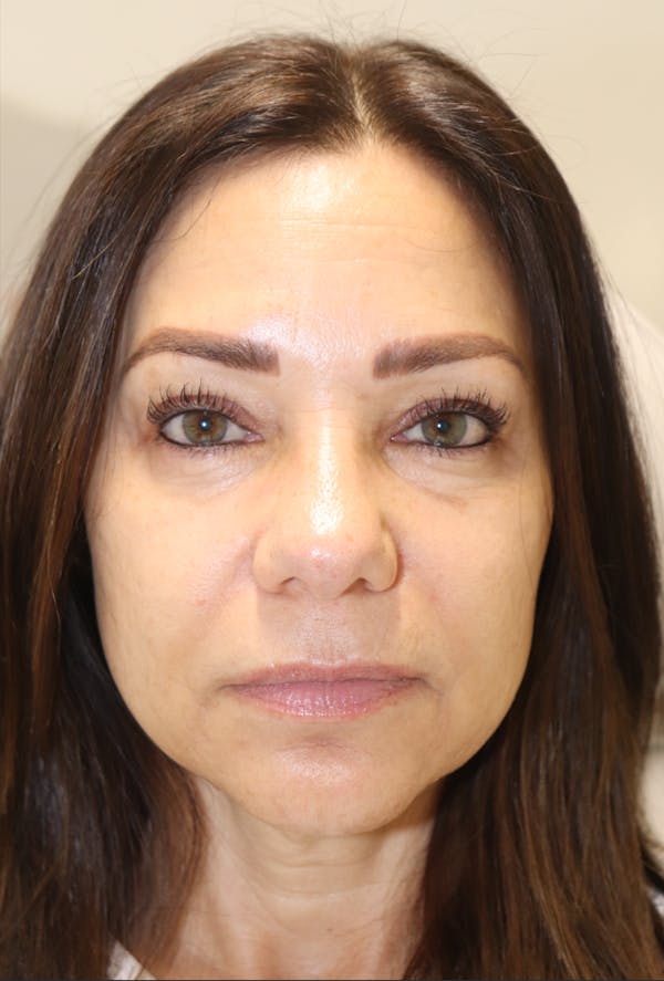 Cheek & Under Eye Filler Before & After Gallery - Patient 145354924 - Image 3