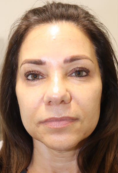 Cheek & Under Eye Filler Before & After Gallery - Patient 145354924 - Image 4