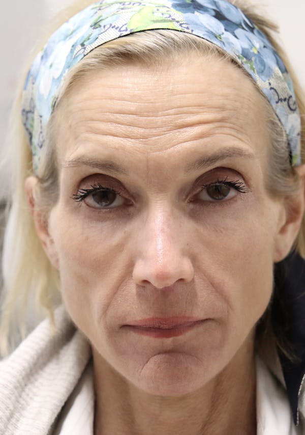 Cheek & Under Eye Filler Before & After Gallery - Patient 145354929 - Image 1