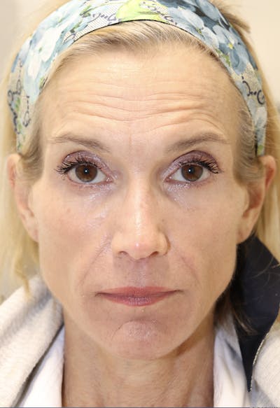 Cheek & Under Eye Filler Before & After Gallery - Patient 145354929 - Image 2