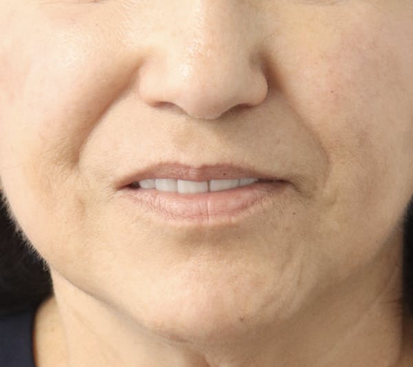 Lip Filler Before & After Gallery - Patient 145354907 - Image 1