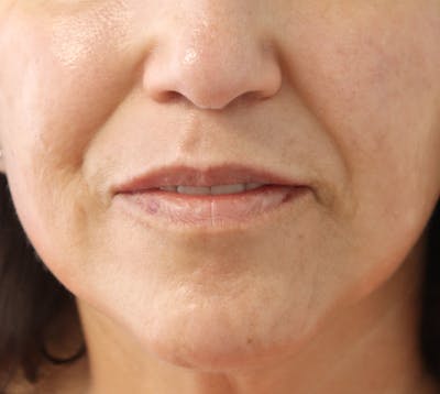Lip Filler Before & After Gallery - Patient 145354907 - Image 2