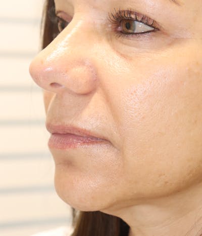 Lip Filler Before & After Gallery - Patient 145354904 - Image 1