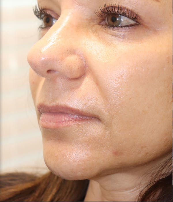 Lip Filler Before & After Gallery - Patient 145354904 - Image 2