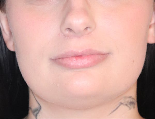 Lip Filler Before & After Gallery - Patient 145354906 - Image 1