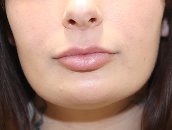 Lip Filler Before & After Gallery - Patient 145354906 - Image 2