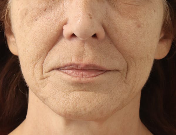 Lip Filler Before & After Gallery - Patient 145354905 - Image 1