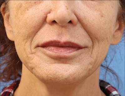 Lip Filler Before & After Gallery - Patient 145354905 - Image 2