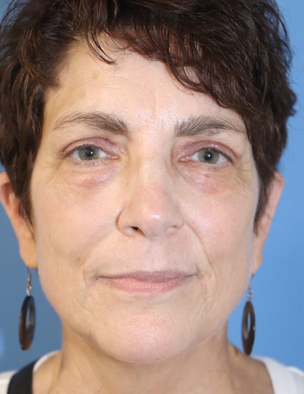 AccuTite Before & After Gallery - Patient 145354896 - Image 2