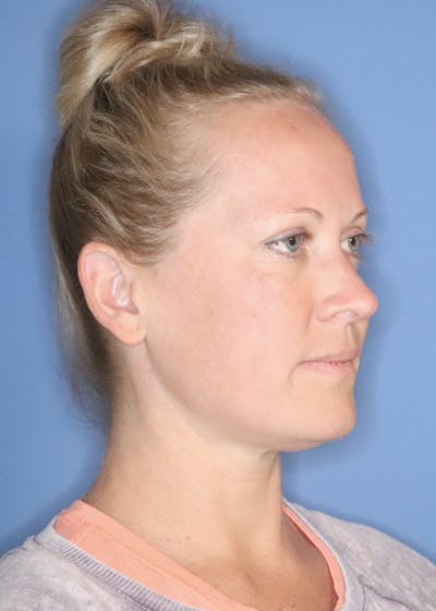 Cheek & Under Eye Filler Before & After Gallery - Patient 145354925 - Image 1