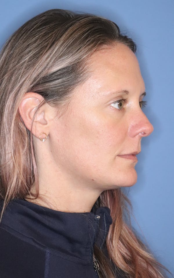 Cheek & Under Eye Filler Before & After Gallery - Patient 145843865 - Image 4