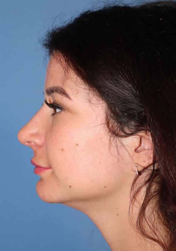 Microneedling Before & After Gallery - Patient 145354950 - Image 3