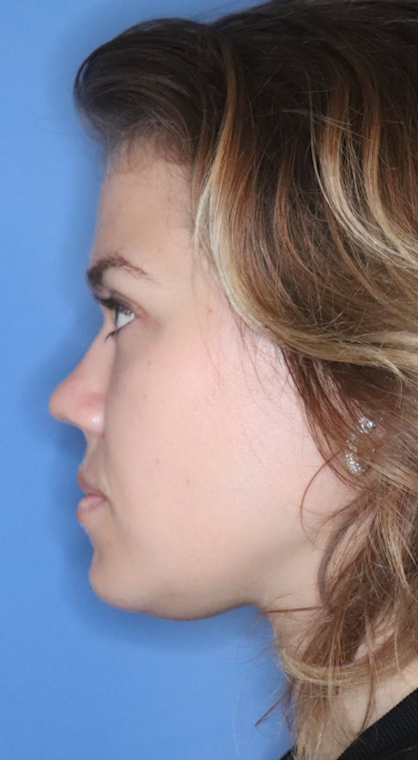 Rhinoplasty Before & After Gallery - Patient 120346808 - Image 3