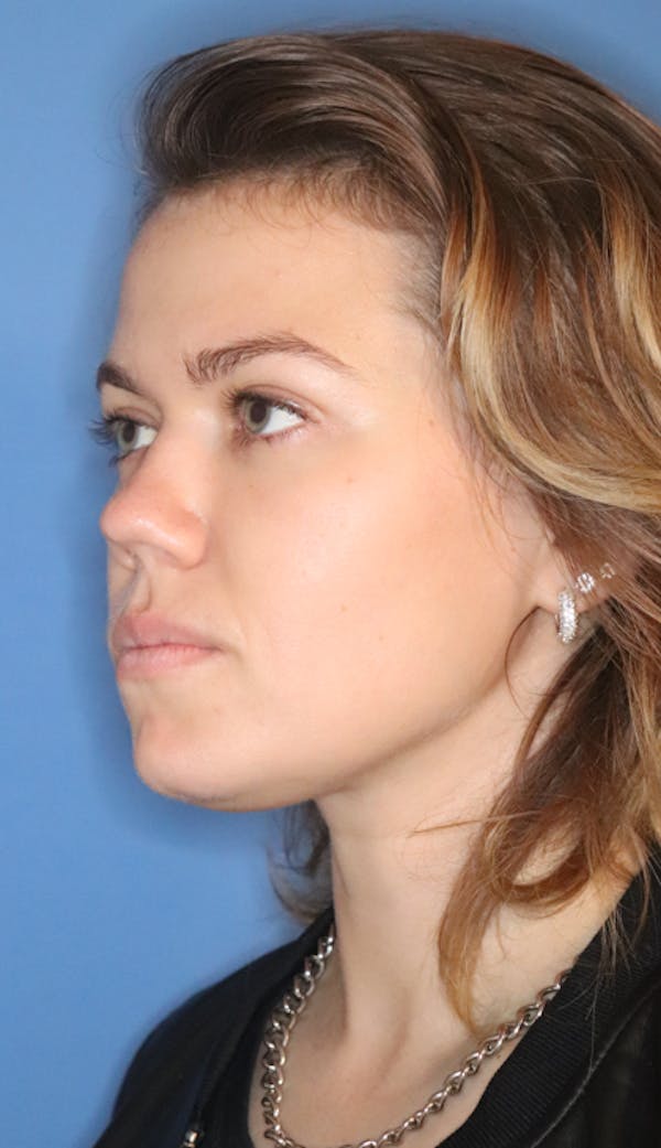 Rhinoplasty Before & After Gallery - Patient 120346808 - Image 5
