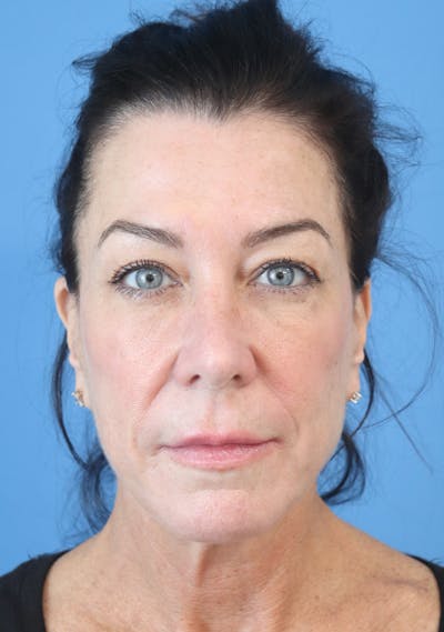 Cheek & Under Eye Filler Before & After Gallery - Patient 148828604 - Image 2