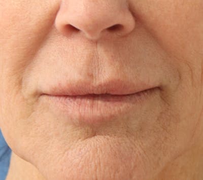 Lip Filler Before & After Gallery - Patient 144976766 - Image 1